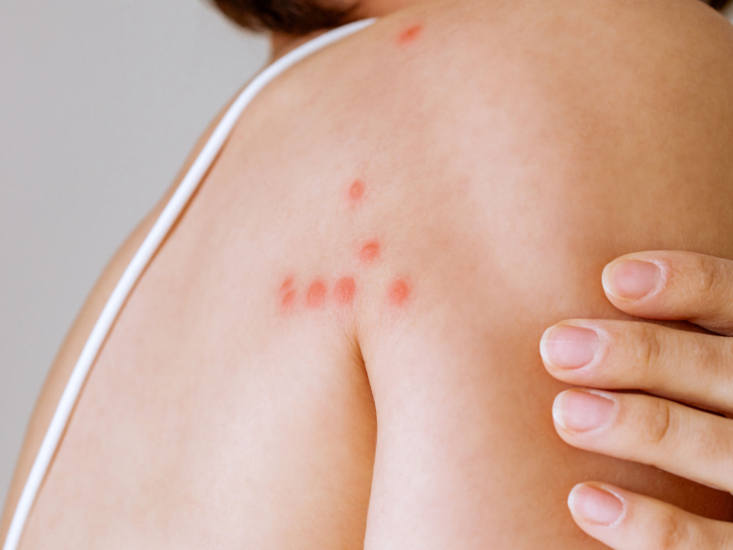 Lineare Bisse von einer Bettwanze auf der Schulter einer Frau